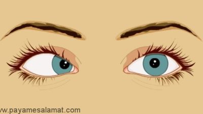 علل، نشانه ها و درمان فلج عصب ششم چشم