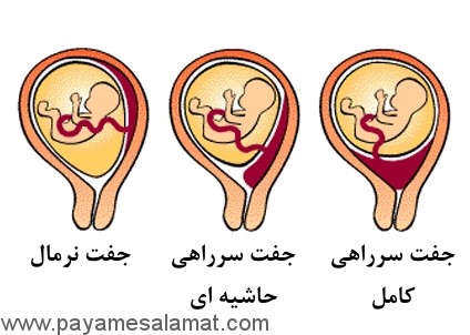 نشانه ها، درمان ها و عوامل خطر برای ابتلا به جفت سرراهی