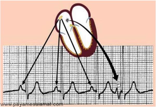 ضربان زودرس دهلیزی یا اختلالات ریتم با منشا دهلیزی PAC