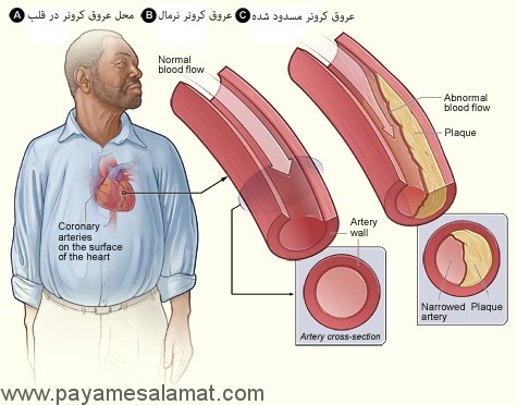 شکل A محل عروق کرونر در قلب را نشان می دهد. شکل B شریان کرونر نرمال با جریان طبیعی خون را نشان می دهد. تصویر الحاقی نیزز یک مقطع شریان کرونر نرمال نشان می دهد. شکل C شریان باریک شده نشای از رسوب پلاک را نشان می دهد. ایجاد پلاک جریان خون غنی از اکسیژن از طریق شریان محدود می کند. تصویر الحاقی یک مقطع از عروق پلاک تنگ شده نشان می دهد.
