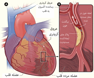 قلب با آسیب عضلانی و عروق مسدود شده