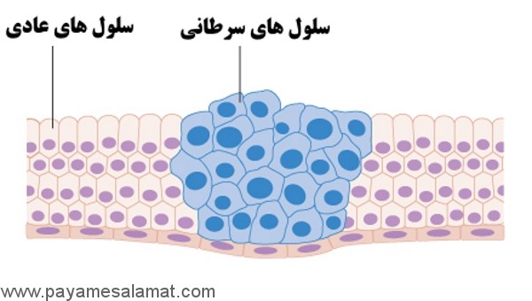 سرطان چیست؟
