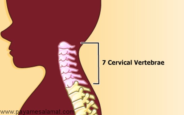 همه چیز درباره فتق دیسک گردن