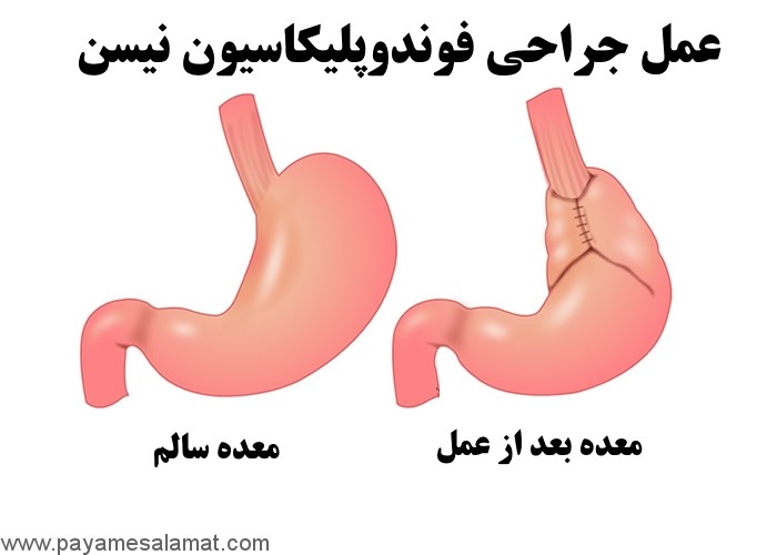 روش های جلوگیری از رفلکس اسید معده و سوزش سر دل