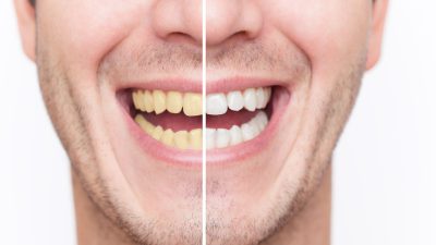 10 روش طبیعی برای سفید کردن دندان