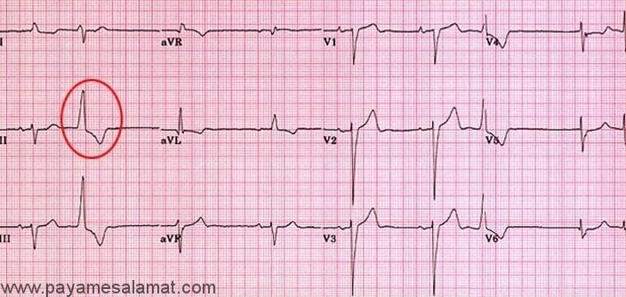 ضربان زودرس بطنی Ventricular Premature Beats چیست؟