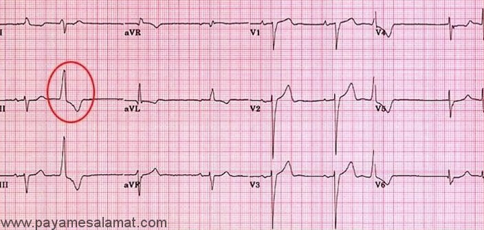 ضربان زودرس بطنی Ventricular Premature Beats