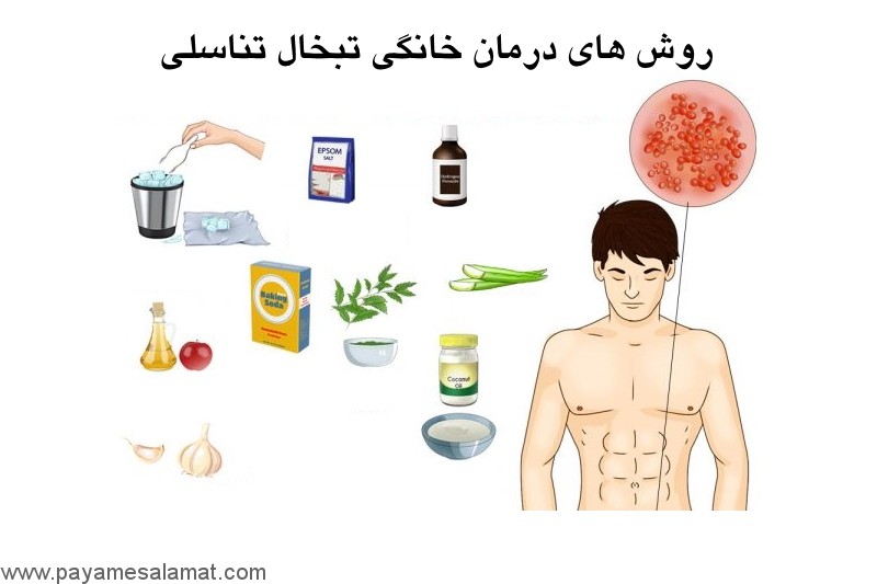 درمان خانگی تبخال مقعدی