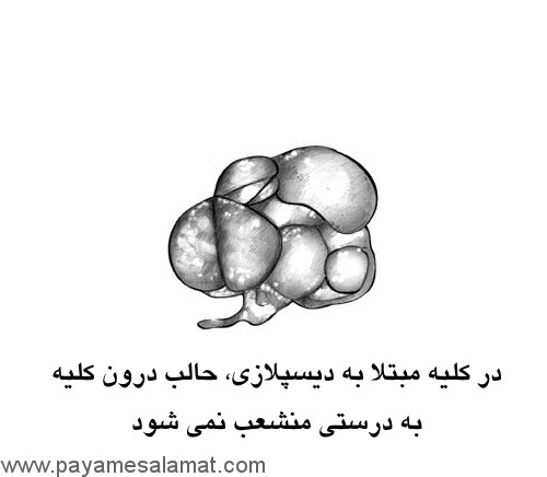 علت و درمان دیسپلازی کلیه و معرفی رژیم غذایی مناسب برای افراد مبتلا به این بیماری