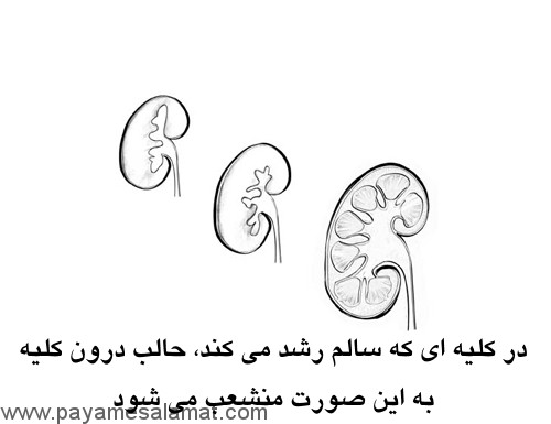 علت و درمان دیسپلازی کلیه و معرفی رژیم غذایی مناسب برای افراد مبتلا به این بیماری