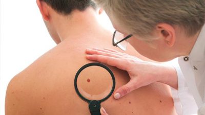 علائم سرطان پوست و کاربرد روش ABCDE برای تشخیص خال های سرطانی