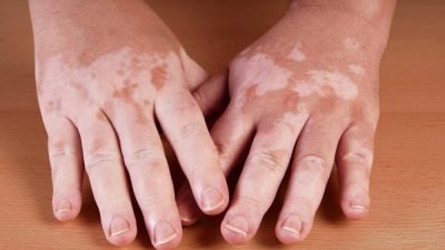 علت بیماری پوستی ویتیلیگو چیست و چگونه می توان این بیماری را درمان کرد؟