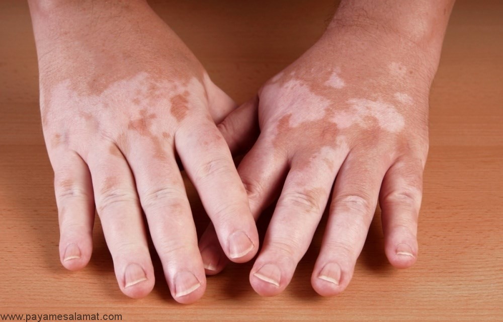 علت بیماری پوستی ویتیلیگو چیست و چگونه می توان این بیماری را درمان کرد؟