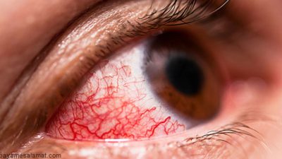 روش های درمان خانگی التهاب ملتحمه (قرمزی چشم)