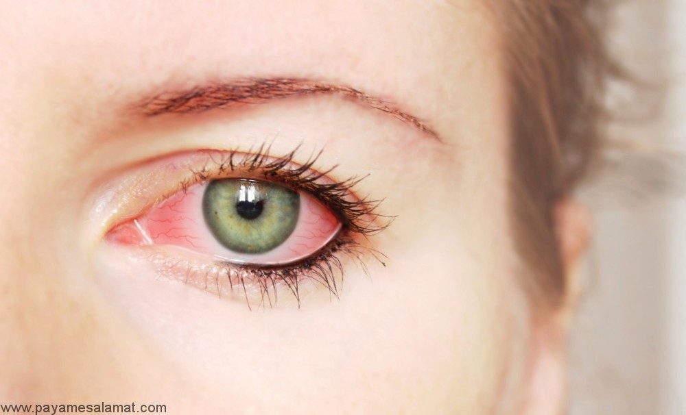 روش های درمان خانگی عفونت چشم