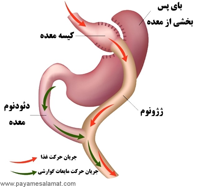نشانه ها، علل، عوارض، تشخیص و درمان ریفلاکس صفرا