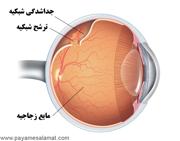 علائم، علل، عوامل خطر و درمان جداشدگی شبکیه