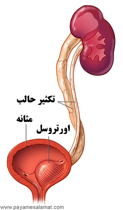 علائم، علل و درمان انسداد حالب