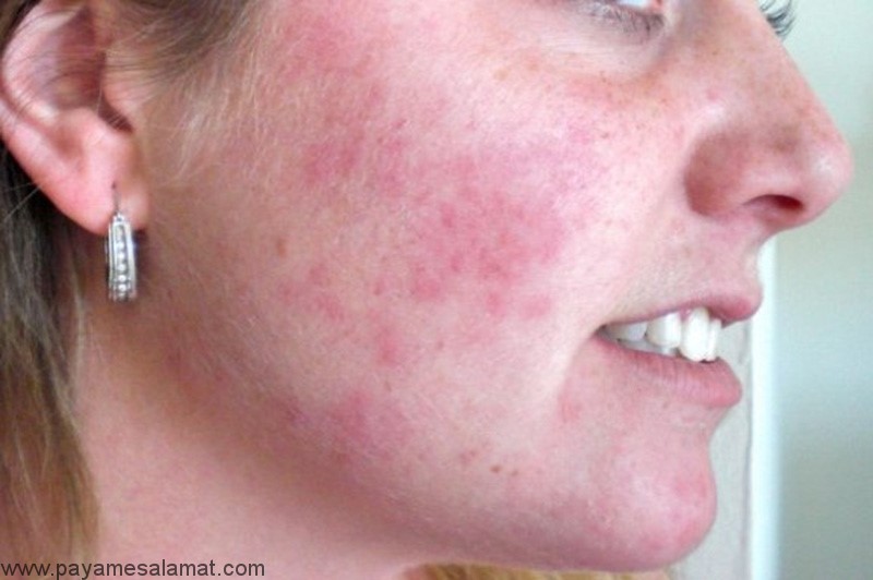 بیماری پوستی باد سرخ (Erysipelas) ؛ علل، علائم و درمان