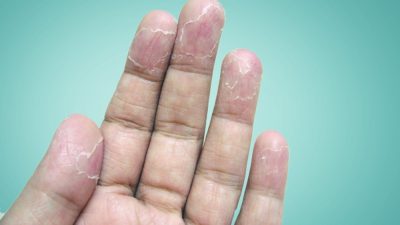 پوسته پوسته شدن دست و انگشتان، علل و درمان موثر
