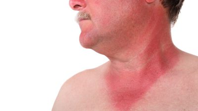 مسمومیت با خورشید ؛ نشانه ها، علل و درمان