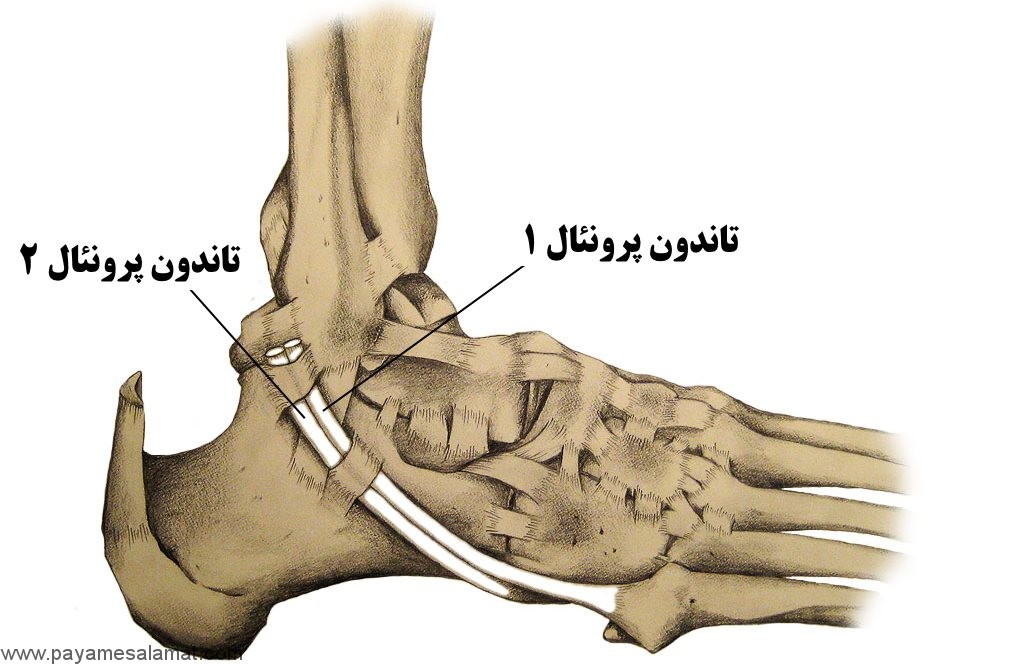 تاندونیت پرونئال یا همان التهاب تاندون پرونئال ؛ علل، نشانه ها، تشخیص، درمان و پیشگیری