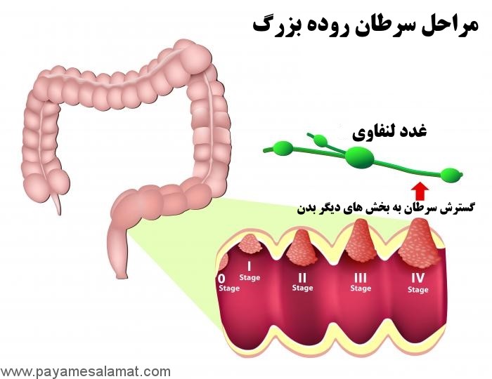 سرطان روده بزرگ (سرطان کولورکتال)؛ علل، نشانه ها و روش های درمان