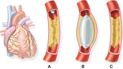 خطرات و مزایا آنژیوپلاستی بعد از حمله قلبی