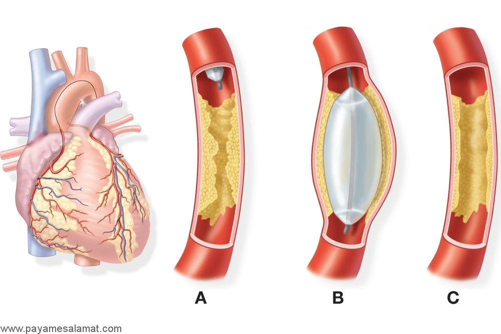 خطرات و مزایا آنژیوپلاستی بعد از حمله قلبی