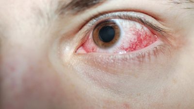 علل خونریزی داخل چشم به همراه روش های درمان و پیشگیری از وقوع آن