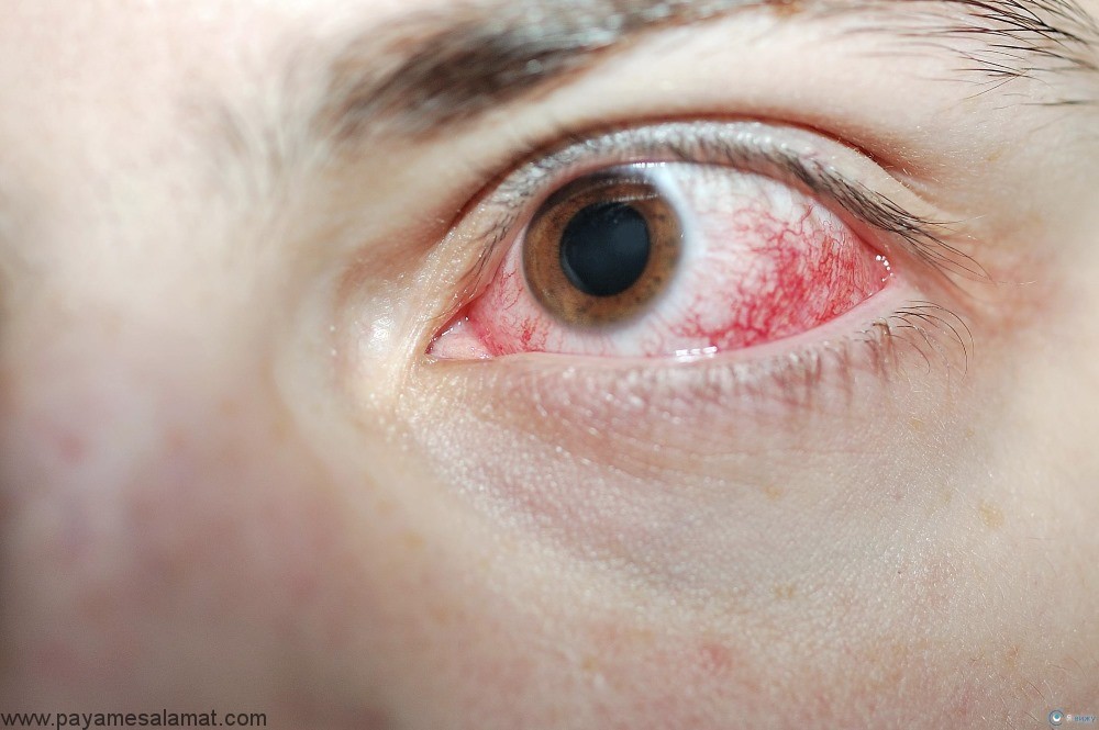 علل خونریزی داخل چشم به همراه روش های درمان و پیشگیری از وقوع آن