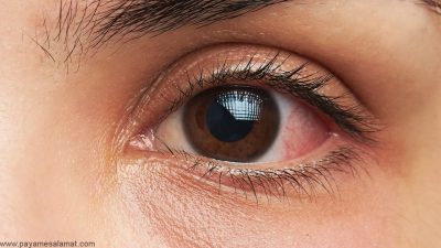 عفونت های چشمی ؛ علل، نشانه ها، تشخیص و روش های درمان پزشکی و خانگی آن