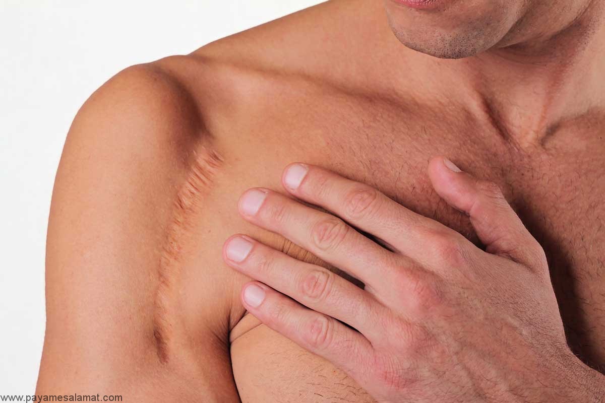 روش های درمان گوشت اضافی یا بافت اسکار روی پوست به کمک مواد طبیعی