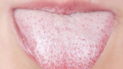 روش های خانگی و طبیعی برای درمان سفیدی روی زبان