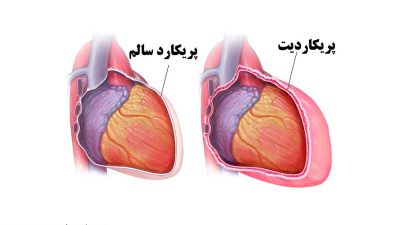 علائم تجمع مایع در اطراف قلب (علائم افیوژن پریکارد یا پریکاردیت)