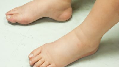 روش های خانگی و طبیعی برای درمان تورم پاها