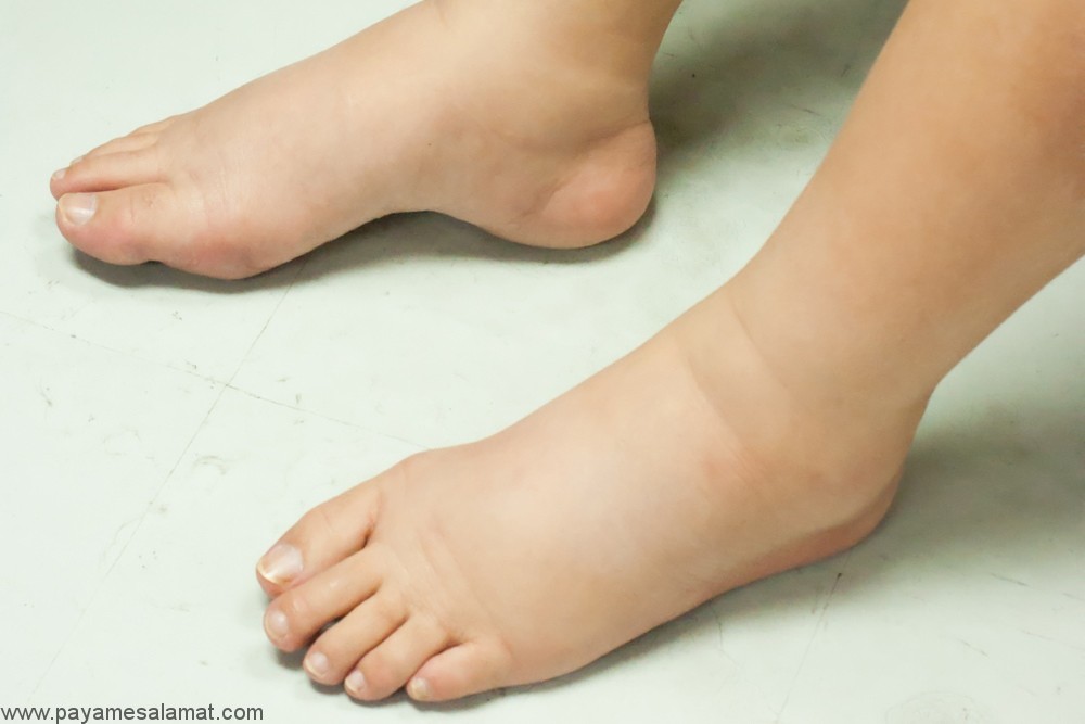 روش های خانگی و طبیعی برای درمان تورم پاها