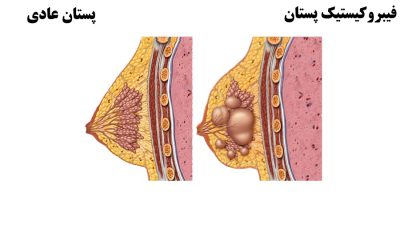 فیبروکیستیک پستان ؛ نشانه ها، علل، عوامل خطر و روش های درمان