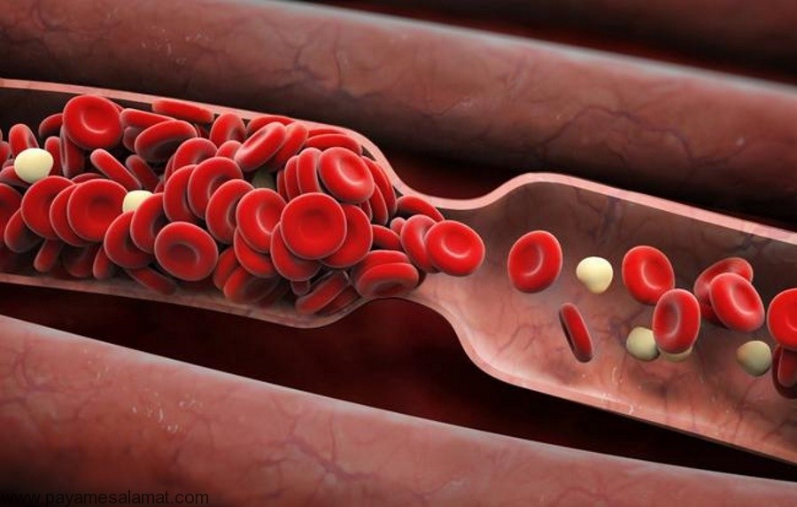 نشانه ها و علائم لخته شدن خون در بدن چیست؟