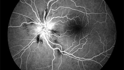 انسداد ورید شبکیه چشم ؛ علل، نشانه ها، عوامل خطر، روش های تشخیص و درمان
