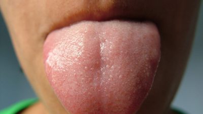 درمان سندرم سوزش زبان به کمک مواد طبیعی و روش های خانگی