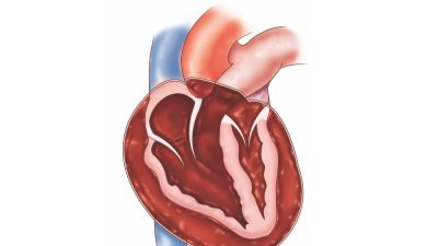 تامپوناد قلبی ؛ علل، نشانه ها، روش های تشخیص و روش های درمان