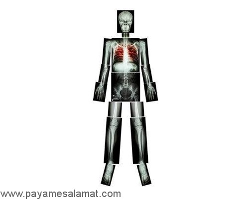 بیماری هایی که باعث کاهش وزن می شوند