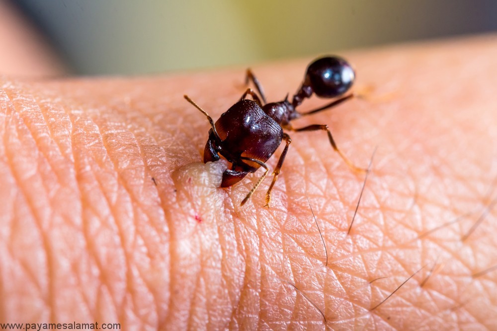 روش های خانگی درمان گاز گرفتگی مورچه به کمک مواد طبیعی و ساده