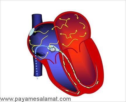 روش تخریب گره AV یا فرسایش فیبریلاسیون دهلیزی