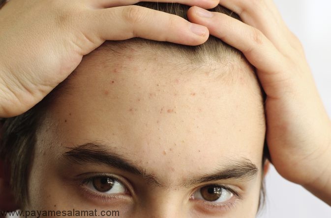 آیا می توان از روی برای درمان آکنه و جای زخم استفاده کرد؟