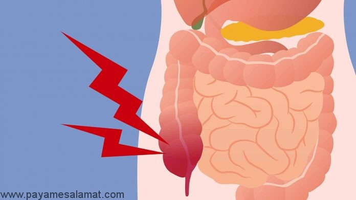 علائم اولیه سرطان کولون