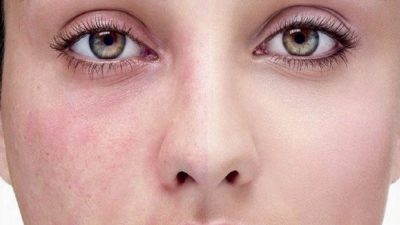 درمان قرمزی صورت با کمک روش های طبیعی