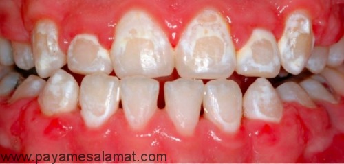 حذف لکه های سفید روی دندان