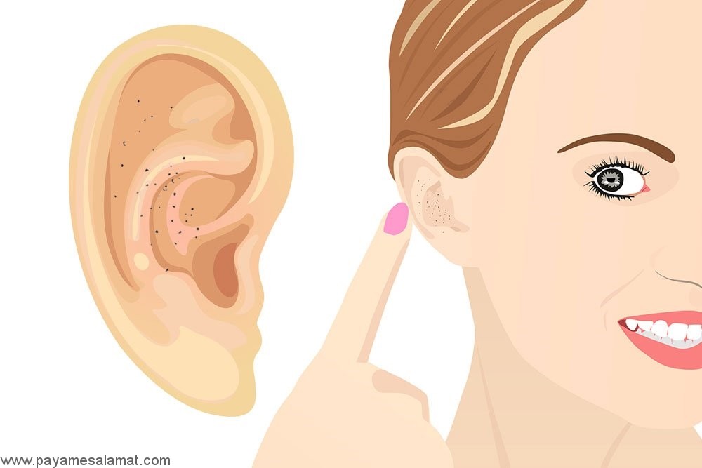 درمان جوش سرسیاه داخل گوش